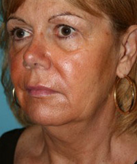 Facelift surgery outcome, reduced facial wrinkles at Darrow Plastic Surgery Brookline