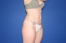 Tummy tuck (abdominoplasty) before and after, patient with flatter stomach at Darrow Plastic Surgery Brookline