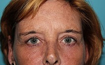 Eyelid Surgery at Darrow Plastic Surgery