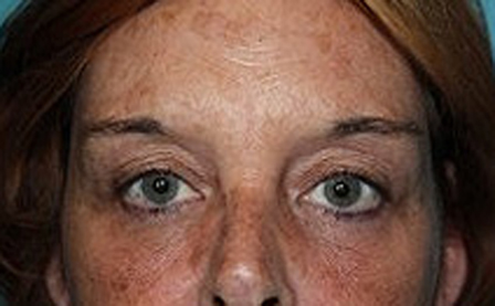Eyelid Surgery at Darrow Plastic Surgery