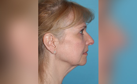 Facelift Surgery at Darrow Plastic Surgery