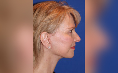 Facelift Surgery at Darrow Plastic Surgery